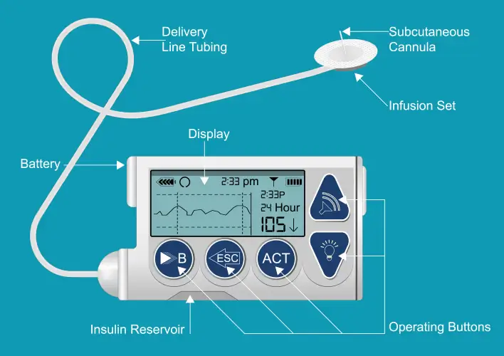 insulin pump therapy for diabetes care