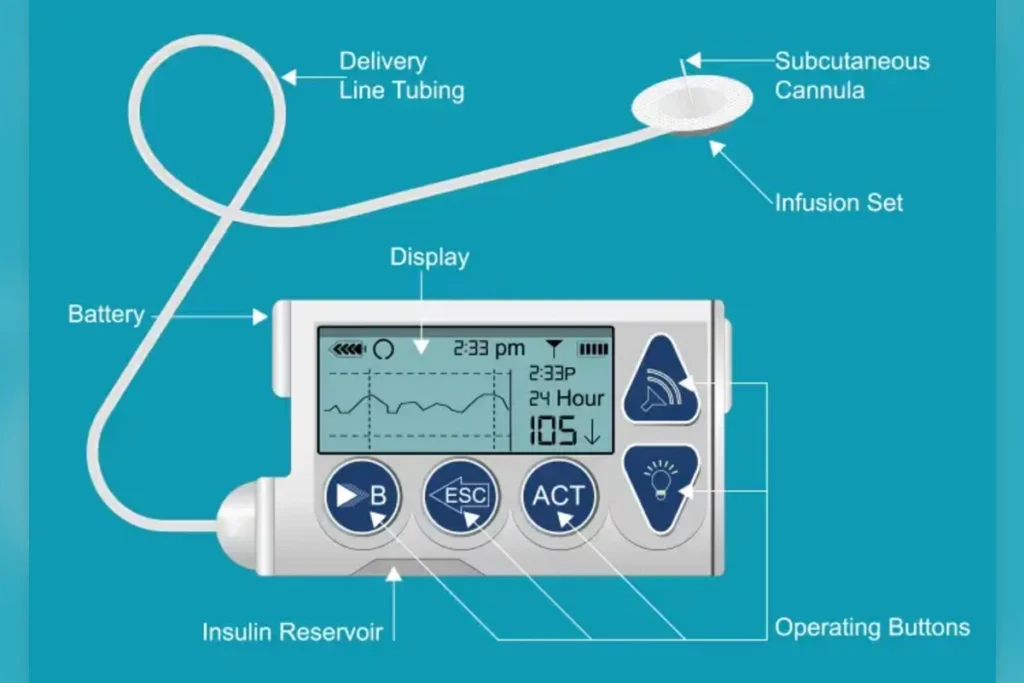 insulin pump therapy for diabetes care